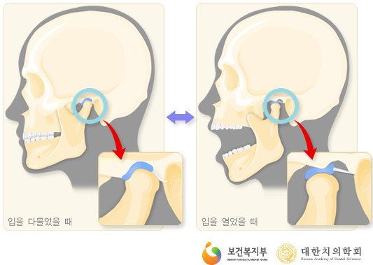 관절돌기의 전방 활주와 관절융기 도식
