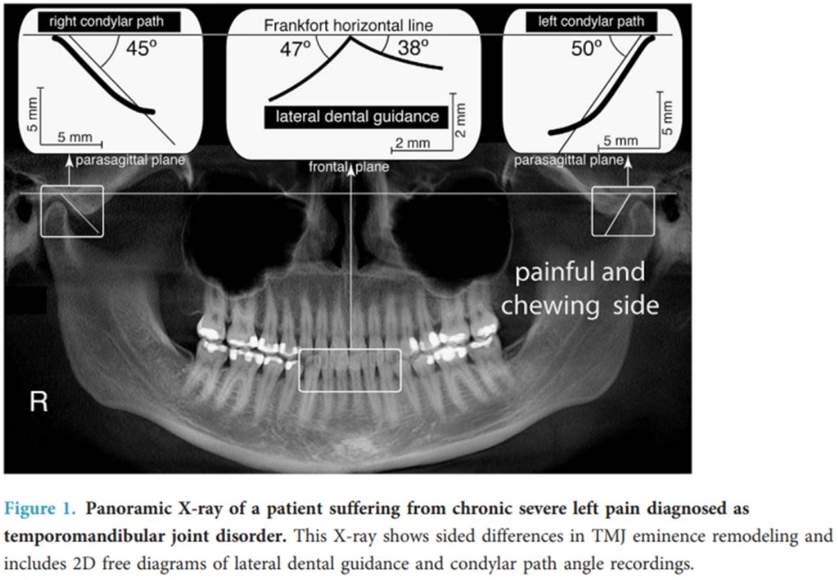 한쪽 씹기 관절 경사 X-ray 예시